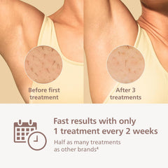 Lumea 9000 Series IPL Hair Removal Device - Permanent Visible Hair Reduction Done at Home